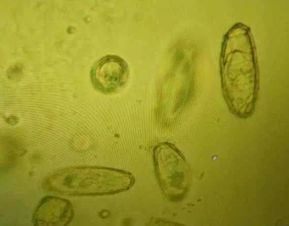 小伙腹泻两周，竟查出感染鬼脸虫