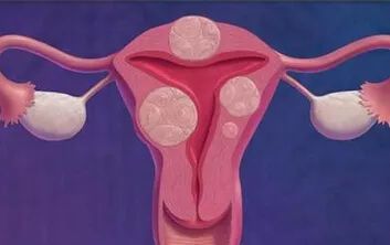 女子因情绪压抑，子宫内竟生长八个肿瘤