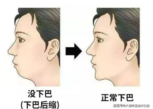 森碟下巴后缩的改善之路