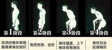 周杰伦强直性脊柱炎疑似加重，粉丝担忧病情恶化，呼吁关爱明星健康