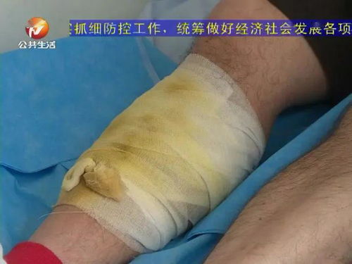老人不幸被五步蛇咬伤，16支血清挽救生命，上演生死时速！